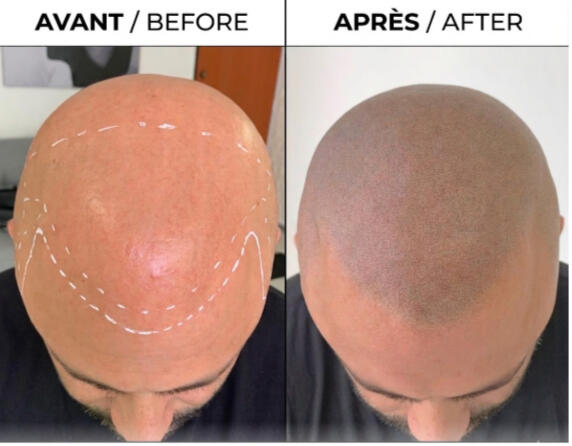 Micropigmentation Capillaire Québec - Scalp Plus Quebec